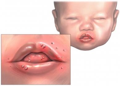 stomatitis ในทารก